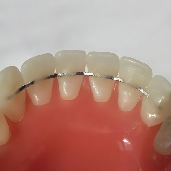 Bonded Retainers in Rock Hill, SC | Tripp Leitner Orthodontics