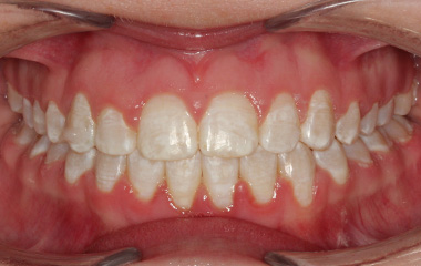 Kanipe - After Braces Results | Tripp Leitner Orthodontics