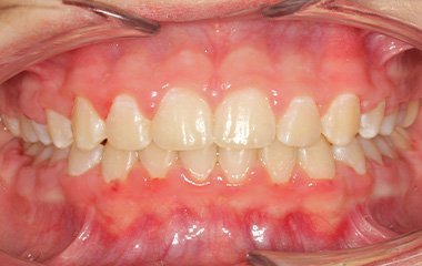 LeBlanc - After Braces Results | Tripp Leitner Orthodontics