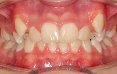 LeBlanc - Before Braces Results | Tripp Leitner Orthodontics