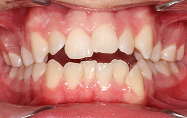 Williams - Before Braces Results | Tripp Leitner Orthodontics