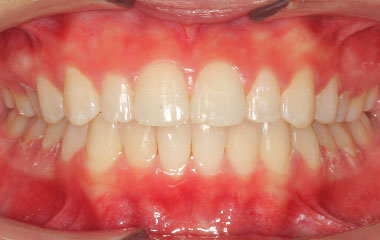 Wallace - Image of Teeth After Invisalign Aligners | Tripp Leitner Orthodontics - Rock Hill, SC