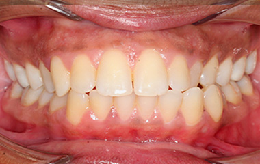 Victoria - Image of Teeth Before Invisalign Aligners | Tripp Leitner Orthodontics - Rock Hill SC