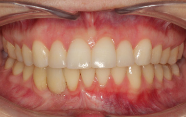 Smile Express Results | Brooke - Image of Teeth After At-Home Aligners | Tripp Leitner Orthodontics - Rock Hill SC