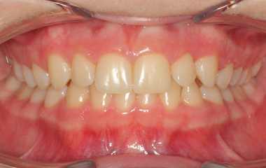 Smile Express Results | Noah - Image of Teeth Before At-Home Aligners | Tripp Leitner Orthodontics - Rock Hill SC