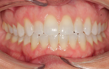 Lindemann - After Smile Express Results | Tripp Leitner Orthodontics