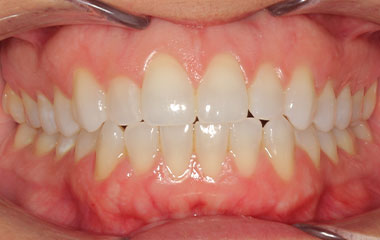 Lindemann - Before Smile Express Results | Tripp Leitner Orthodontics